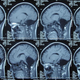 Image for article titled Doctors Discover A Woman With No Cerebellum